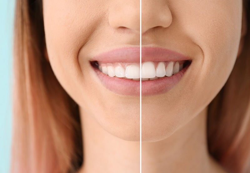 aesthetische-zahnmedizin-berlin-kudamm Bild von Zähnen vor einer Gummy-Smile Behandlung