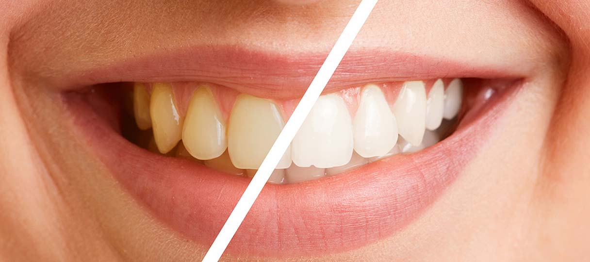 prophylaxe-kudamm-beh Bild: Querschnitt von Zähnen vor und nach dem Bleaching