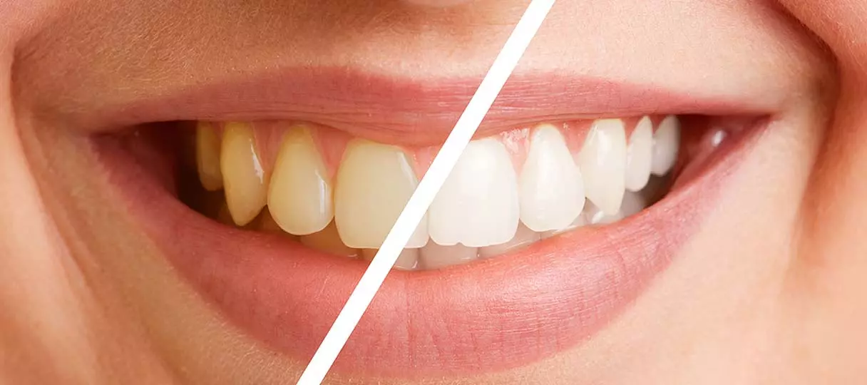 prophylaxe-kudamm-beh Bild: Querschnitt von Zähnen vor und nach dem Bleaching