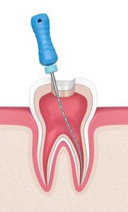 Endodontie Wurzelbehandlung Illustration
