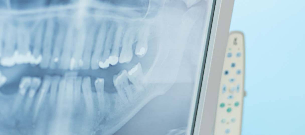 zahnarzt-endodontie Röntgenbild von einem Zahn der eine Wurzelkanalbehandlung hatte.