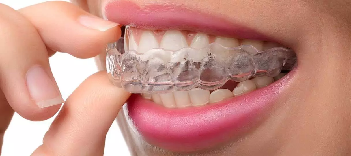 zahnarzt-invisalign Bild bei der Entnahme eines Aligners von den Zähnen