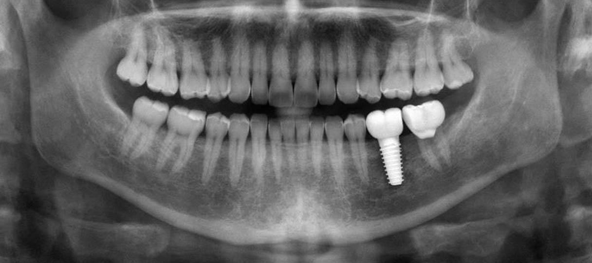 zahnimplantate-berlin-kudamm Röntgenbild eines Kiefers, mit Zahnimplantat und Krone
