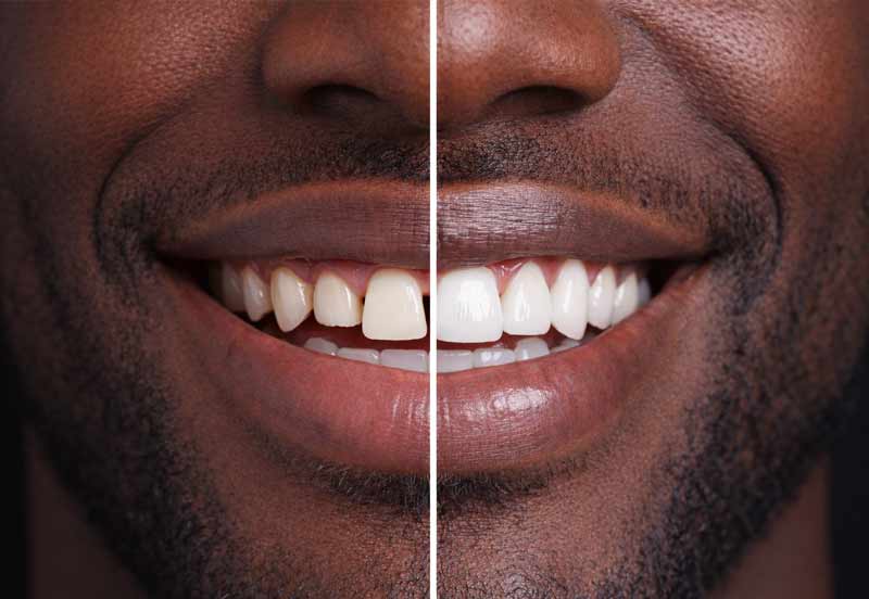 Vorher-/Nachher Aufnahme mit und ohne Veneers